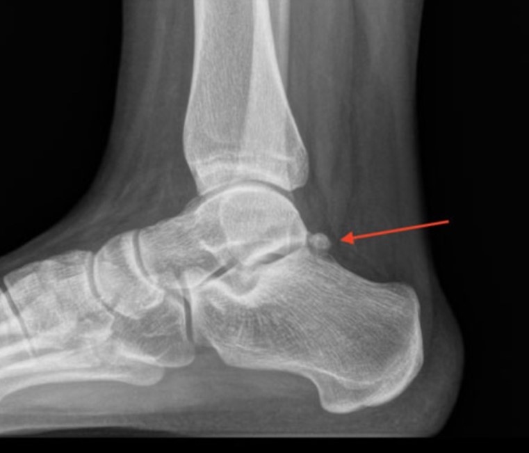 extra bone prominence (aka os trigonum)